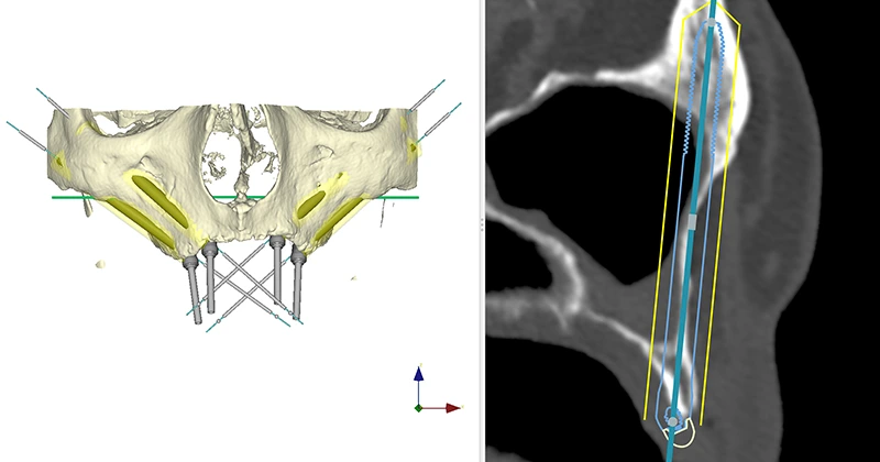 ZYGOMA FOUR tratamiento 1